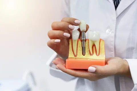 step by step guide to dental implant