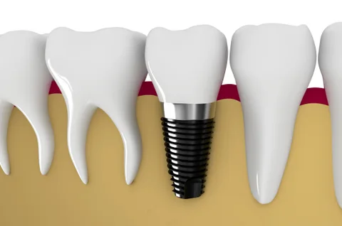 Benefits Of Dental Implants