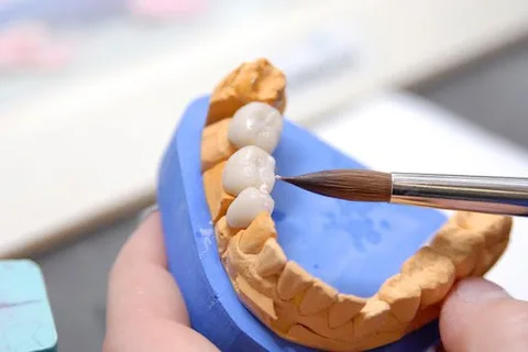 Dental Bridge