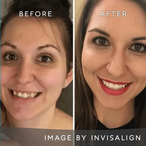 Before and after Invisalign aligners treatment result in Dublin