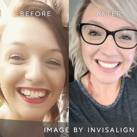 Before and after smile result with Invisalign aligners in Dublin