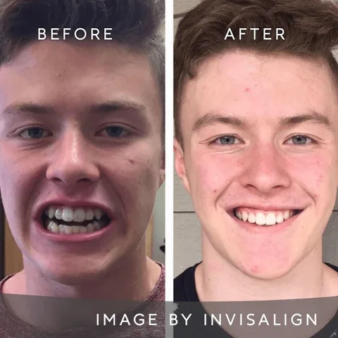 Teen patient’s Invisalign before and after smile result in Dublin