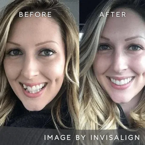 Female Invisalign smile transformation before and after in Dublin