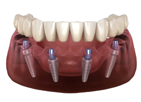 All-on-4 full arch dental implant pricing graphic