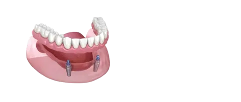 Implant supported denture pricing graphic