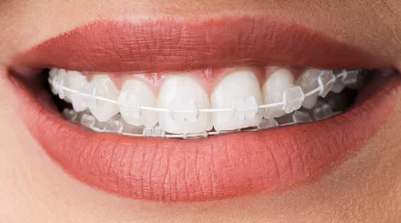 An introduction to QuickStraightTeeth™