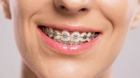 An introduction to QuickStraightTeeth™
