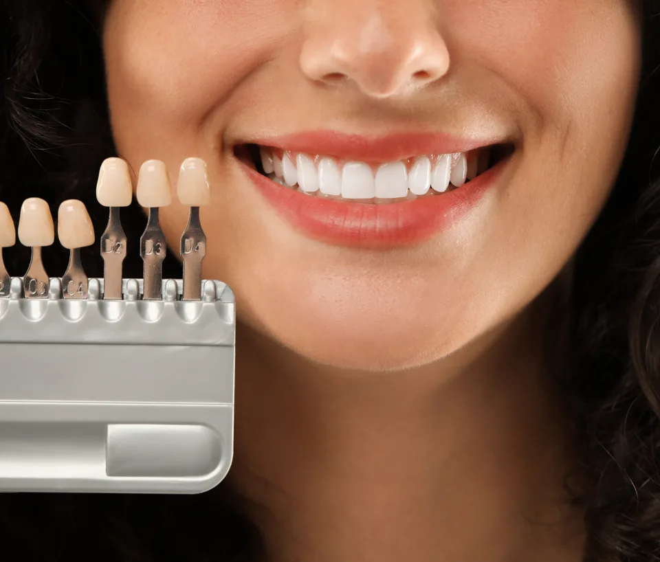 3D Printed Veneer