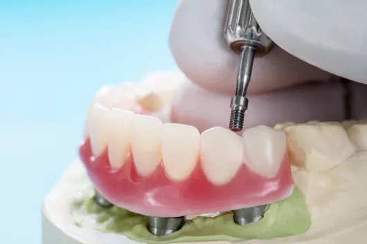 Dental implants: Are they suitable for everyone?