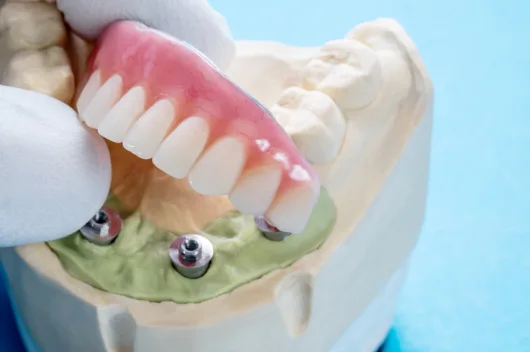 Best practices for caring for dental implants