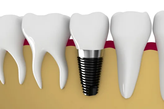 Benefits Of Dental Implants