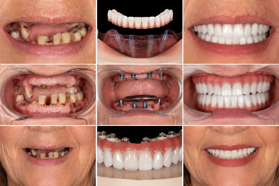 Before and After All-on-4 Smile Transformations