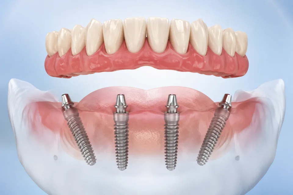 All-on-4 Dental Implants Step by Step: What Happens During Your Smile Transformation?