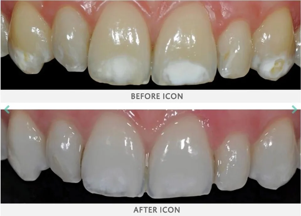 White Spots on Teeth: Causes, Fluorosis and How ICON Treatment Can Help