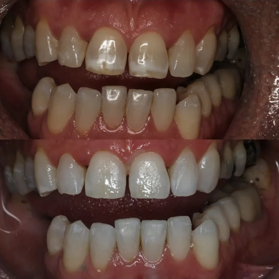 Before: White areas and enamel opacities are clearly visible across the front teeth.