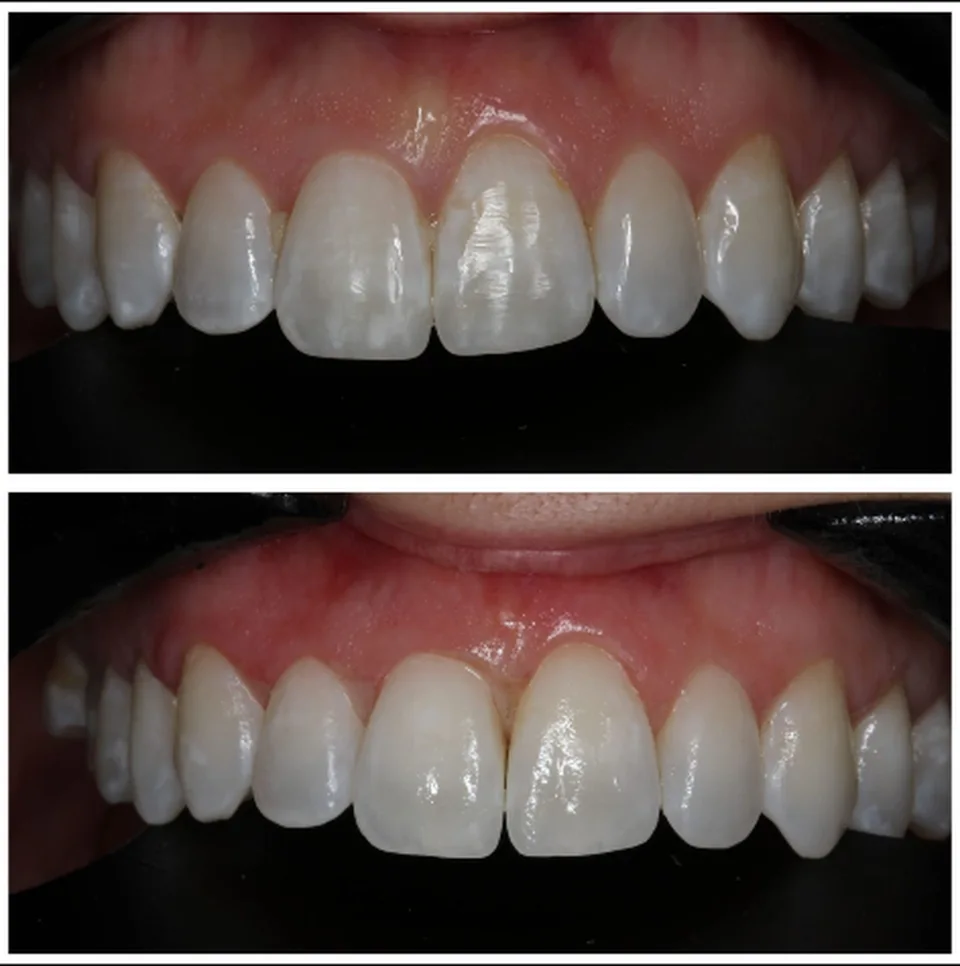After: The appearance of the white areas has been significantly reduced, creating a more uniform appearance across the teeth.
