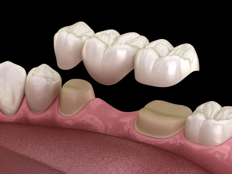 Benefits of Dental Bridges