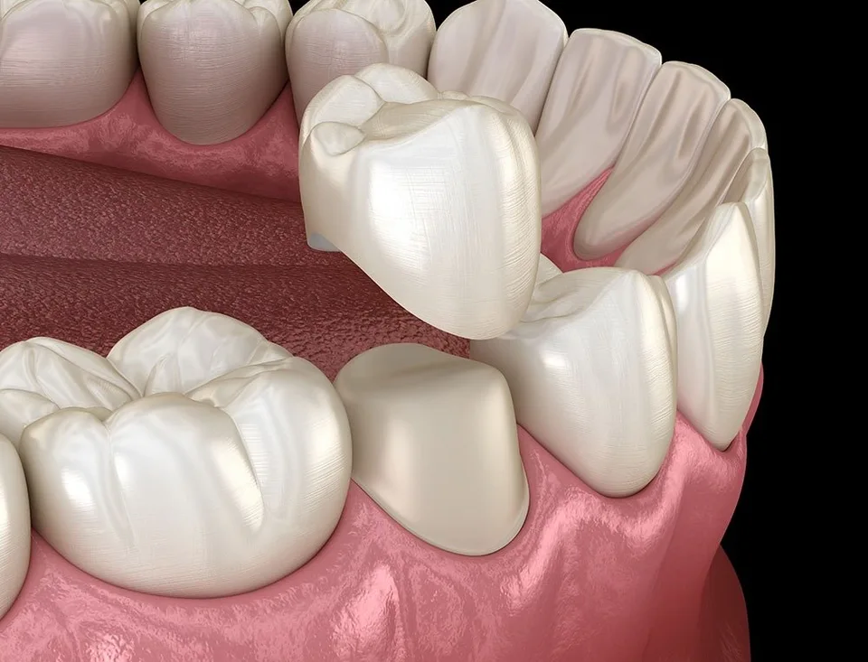 Benefits of Dental Crowns
