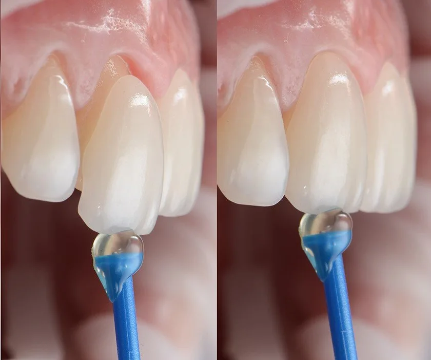 Veneers