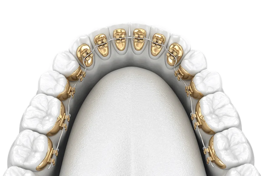 Lingual braces