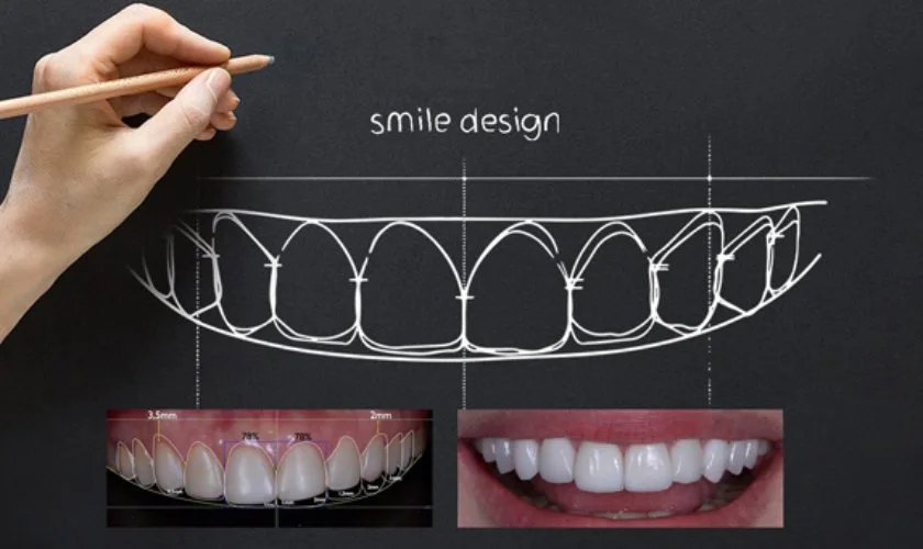 Smile design analysis