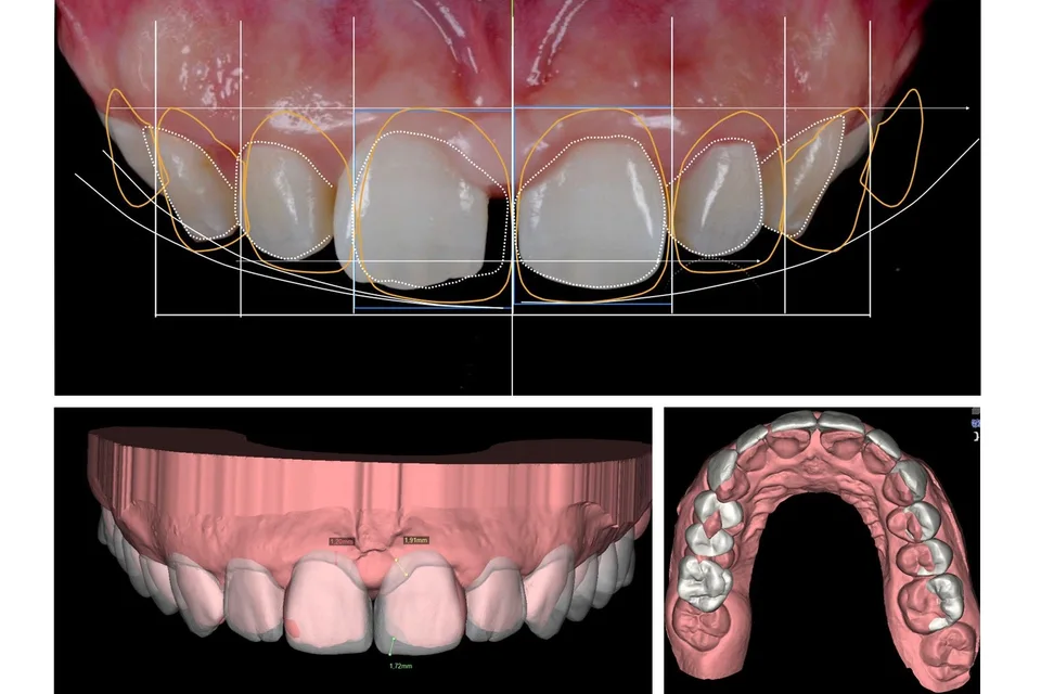 Benefits of digital smile design