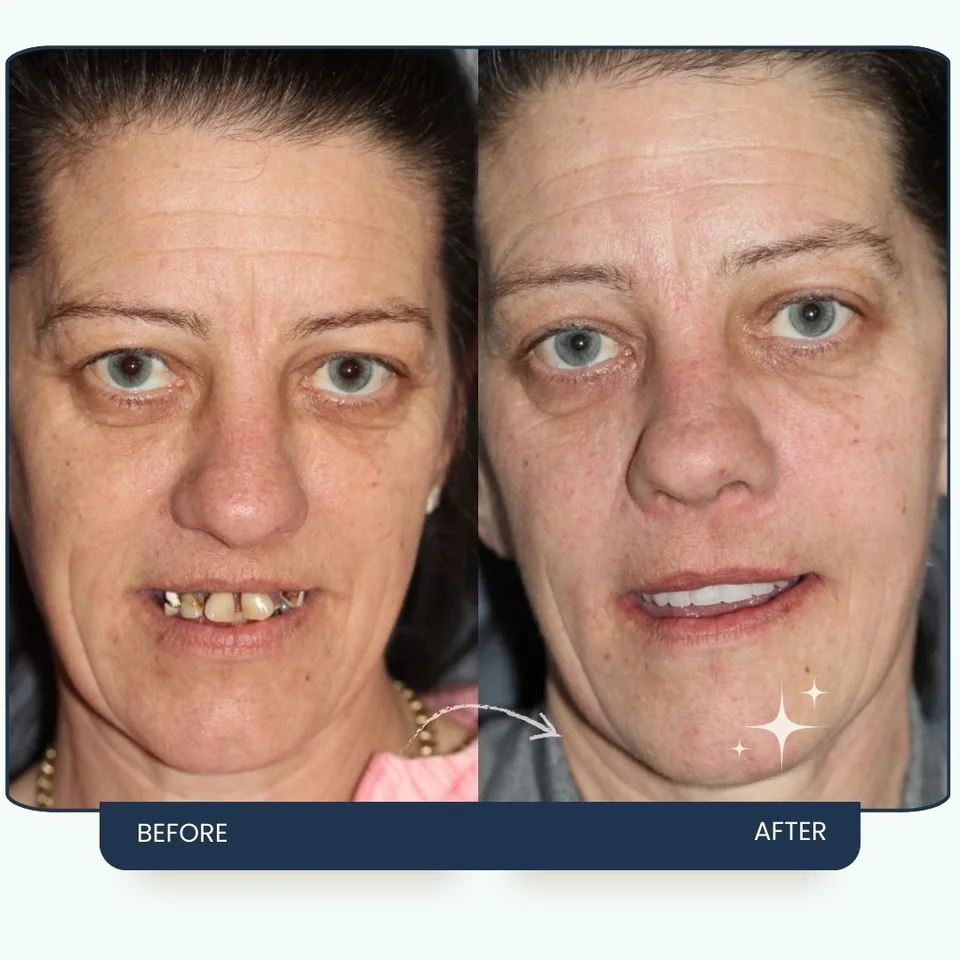 Dental implant treatment result at Maypark Dental Practice