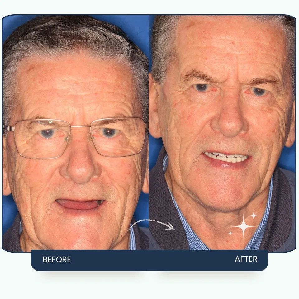 Dental implant smile result at Maypark Dental Practice