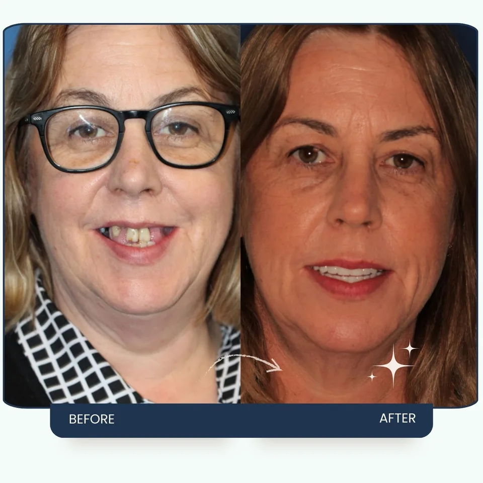 Tooth replacement result at Maypark Dental Practice