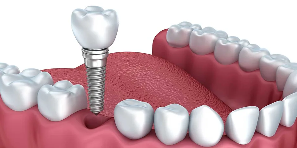 Single tooth implant pricing graphic