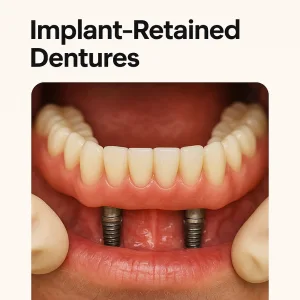 Implant-Retained Dentures